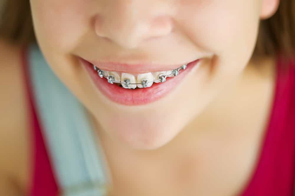 Child orthodontics