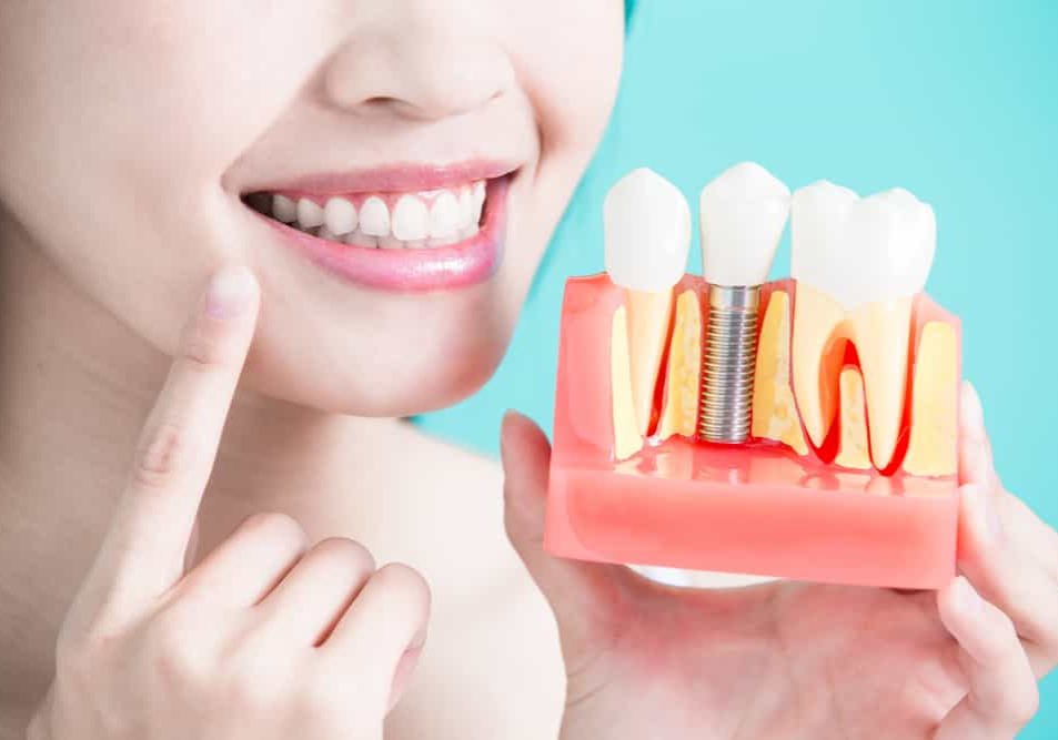 Dental Implants