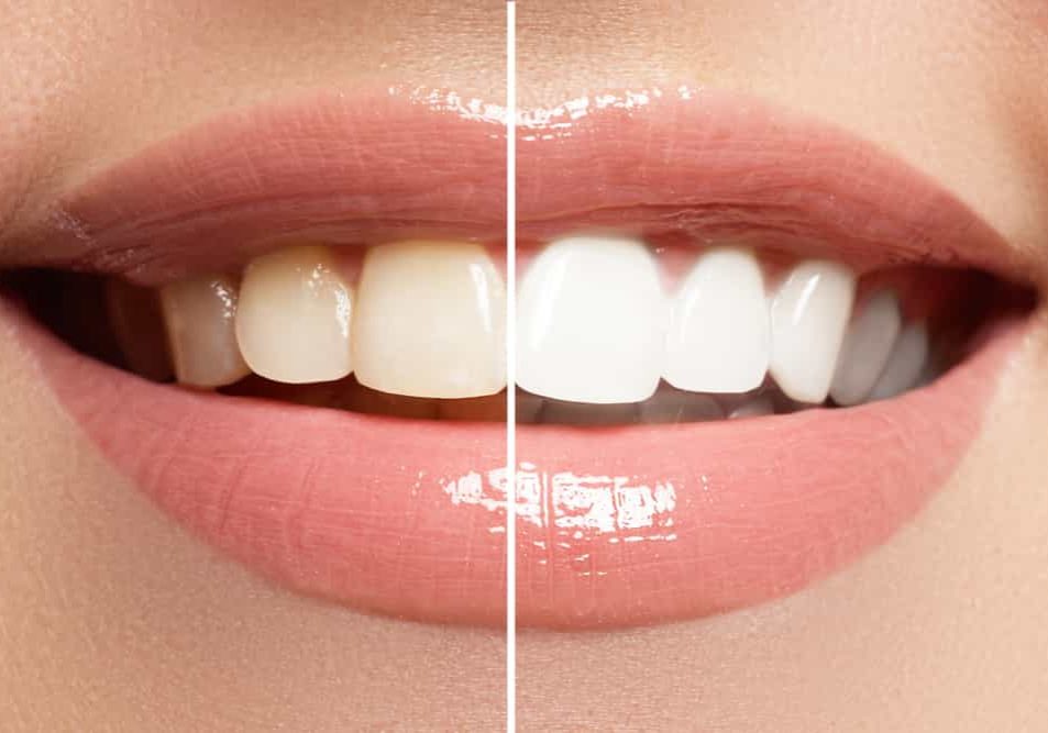 Teeth Whitening